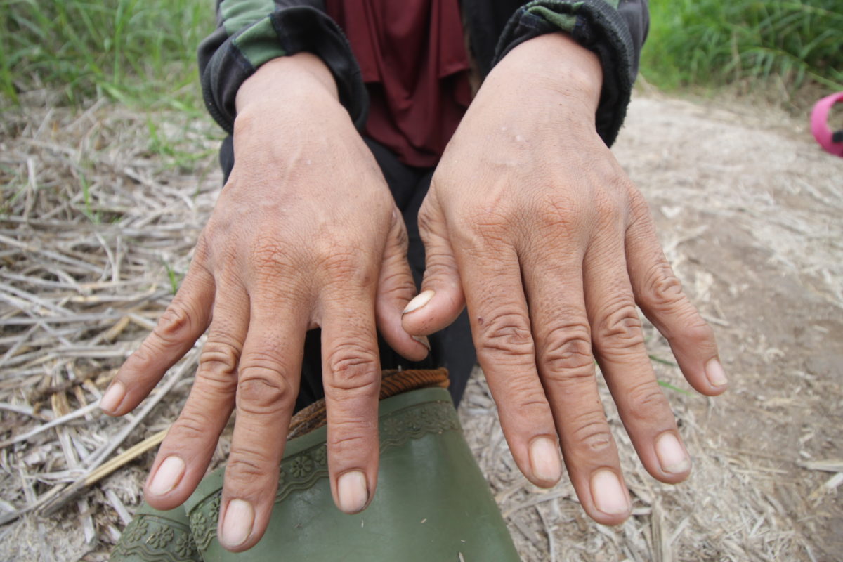 Tangan buruh sawit perempuan yang sehari-hari menyemprot pestisida. Foto: Elviza Diana/ Mongabay Indonesia